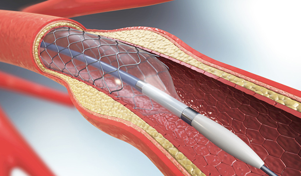  Capillary catheter